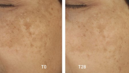 your skin_pigmentbio_c-concentrate_before-after